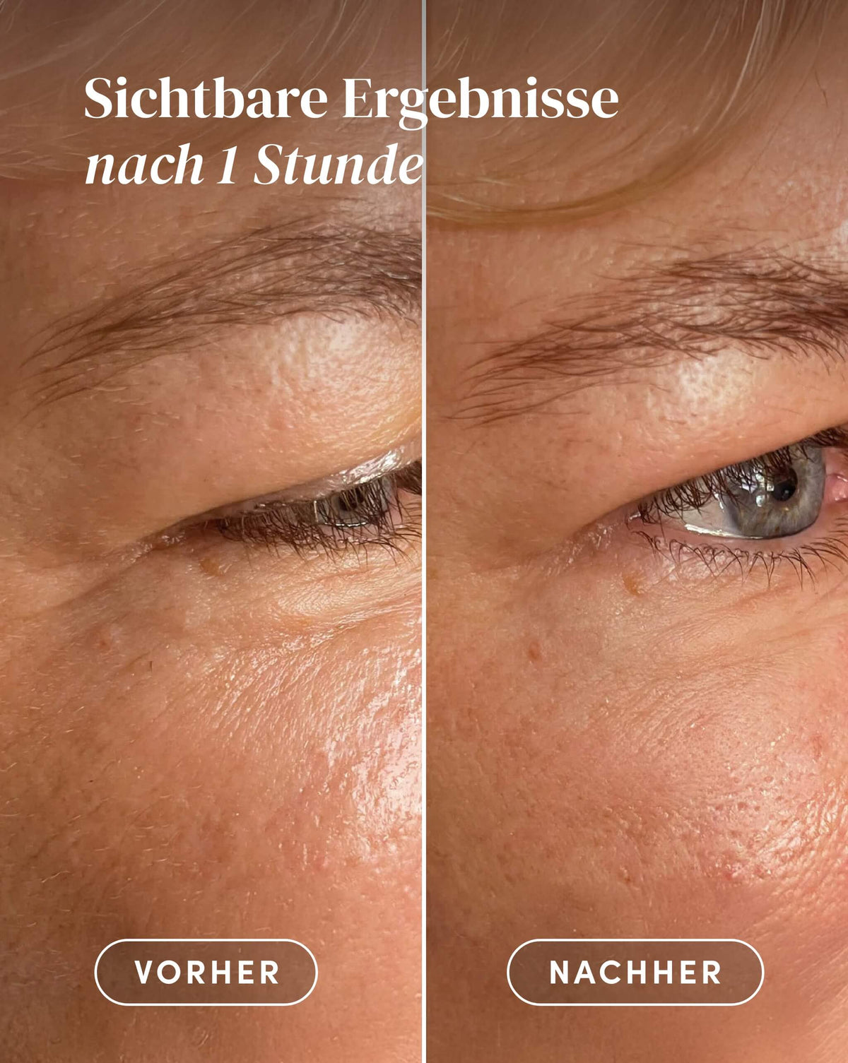 Vorher-Nachher-Ergebnis nach Anwendung der Ectoin Augenpads