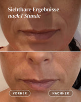 Mund Pads mit Hyaluron