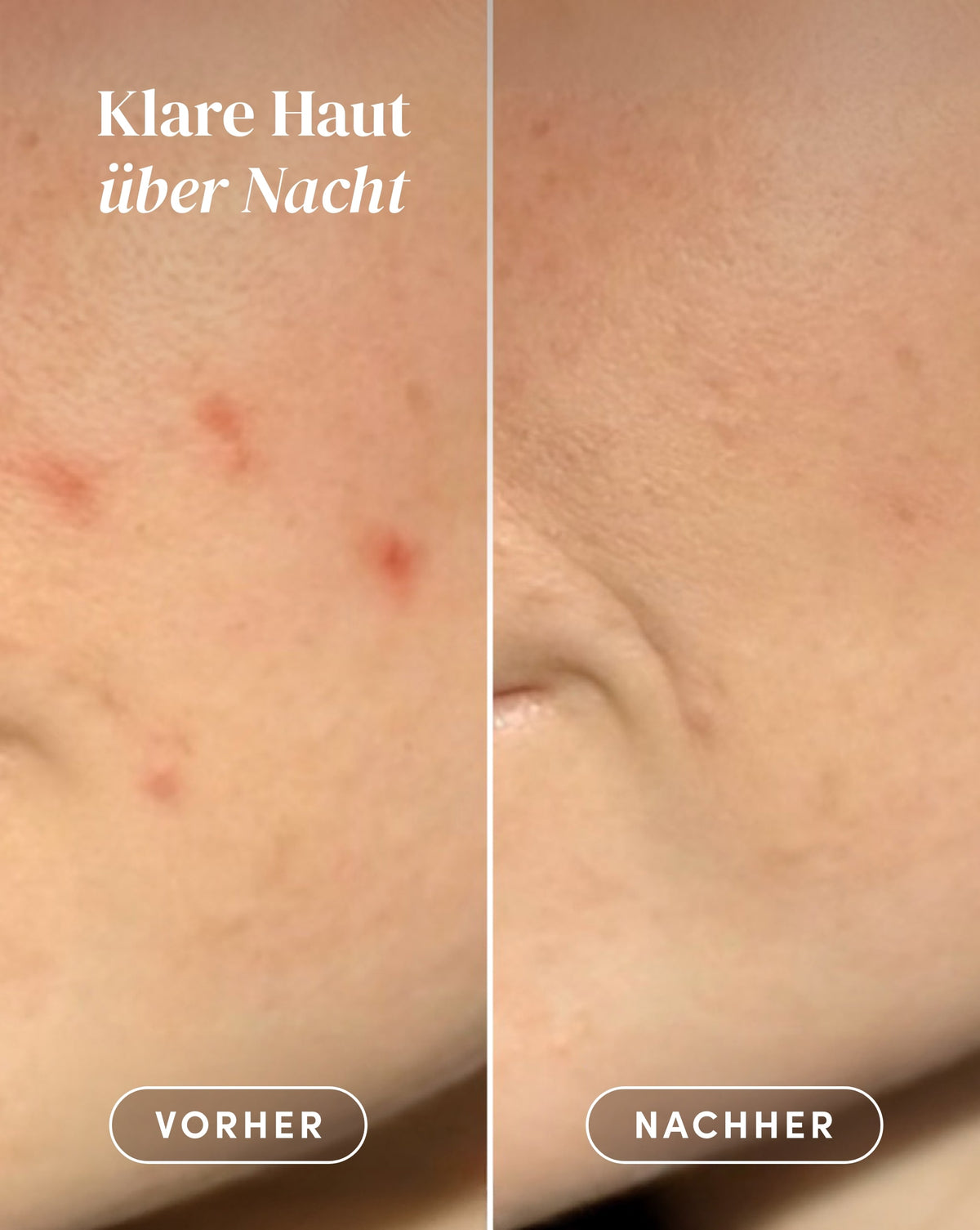 Vorher-Nachher-Ergebnis nach Anwendung der Pickel Patches mit Hydrokolloid