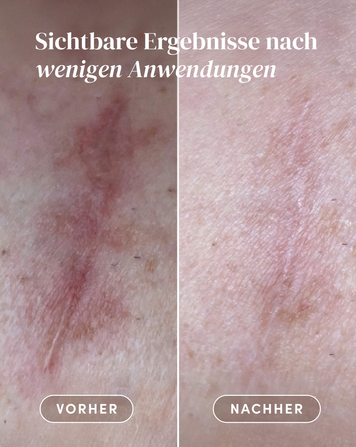 Vorher-Nachher-Ergebnis nach Anwendung der Aloe vera Narben Pads