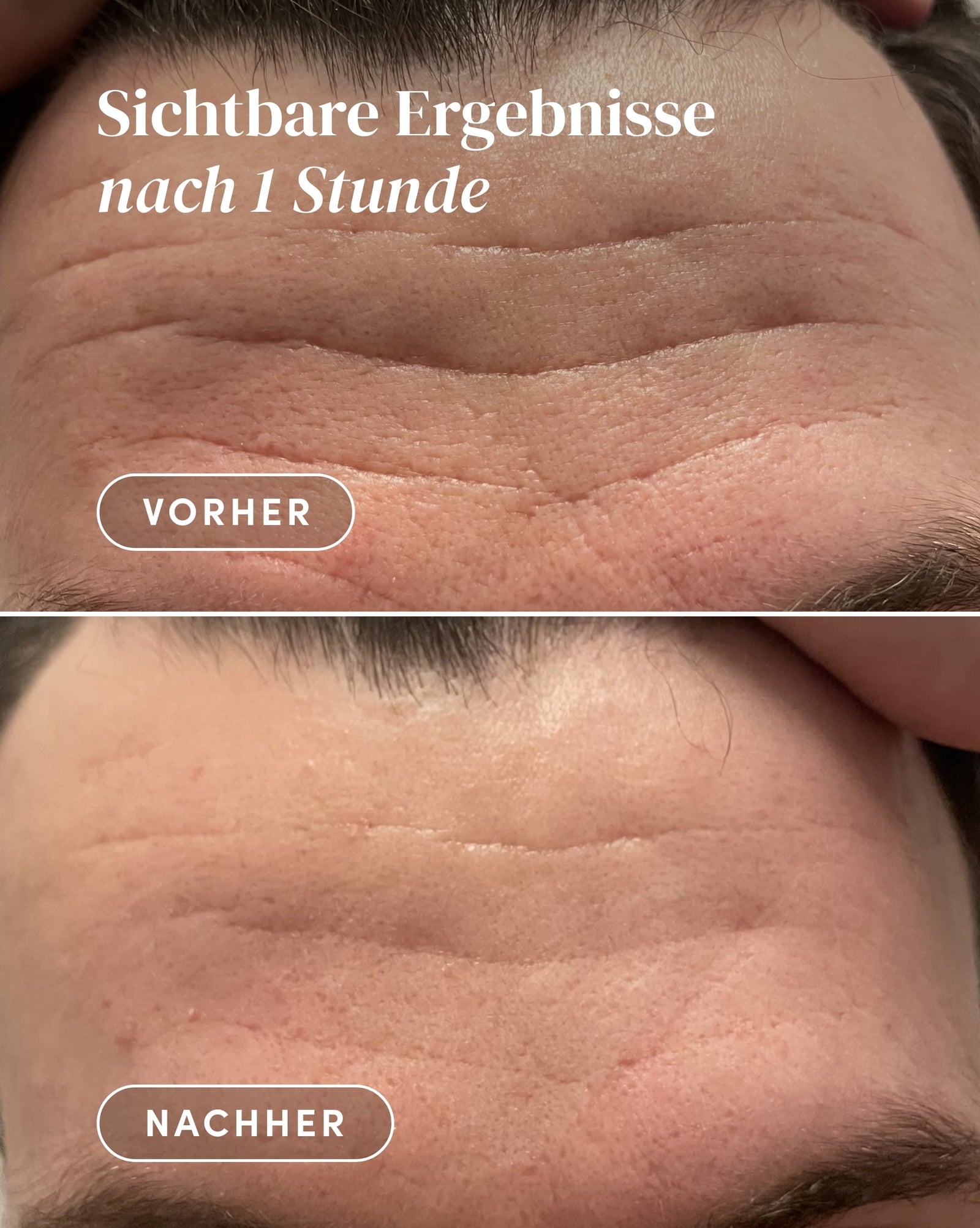 aloe vera haut vorher nachher Zornesfalten Patches Aloe vera