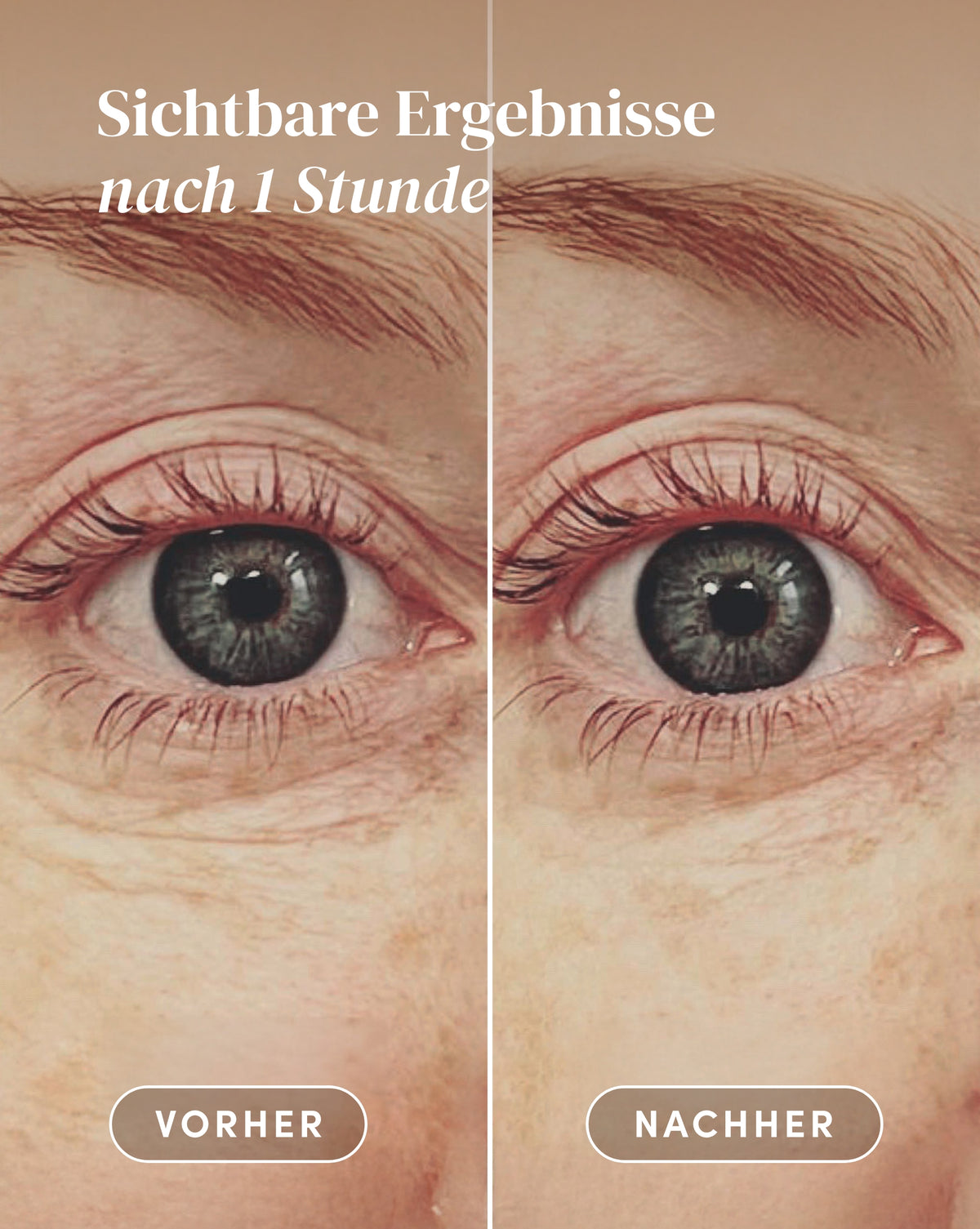 Vorher-Nachher-Ergebnis nach Anwendung der Hyaluron Augenpads