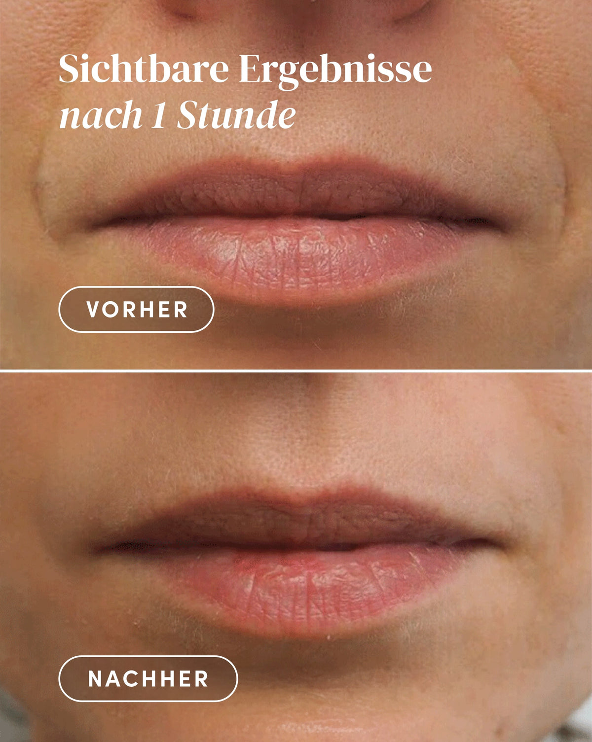 Vorher-Nachher-Ergebnis nach Anwendung der Hyaluron Mund Patches aus Bio-Baumwolle