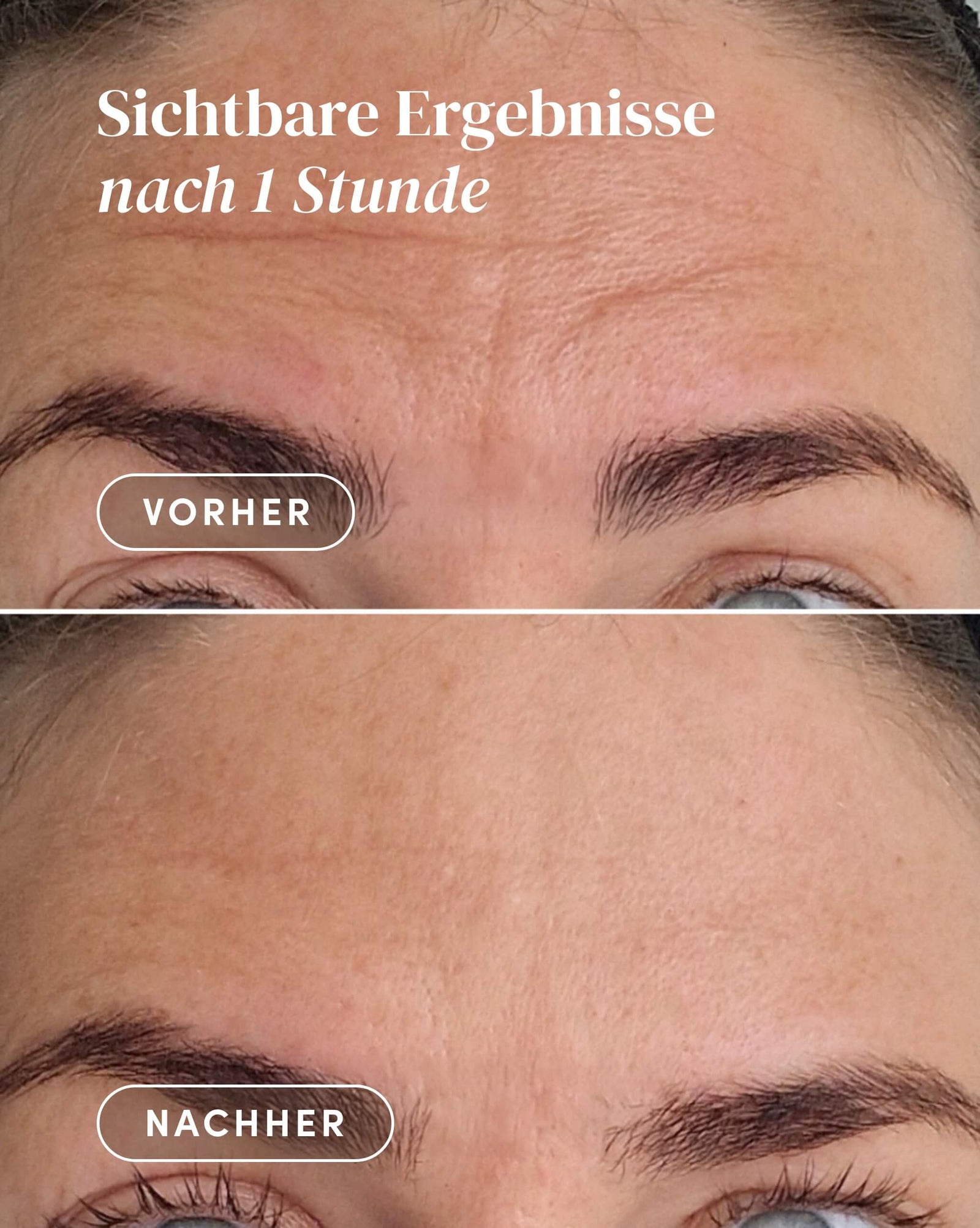 12 Stirnfalten-Pads – Sanfte Anti-Falten-Pflaster Gegen Zornesfalten Und Stirnfalten