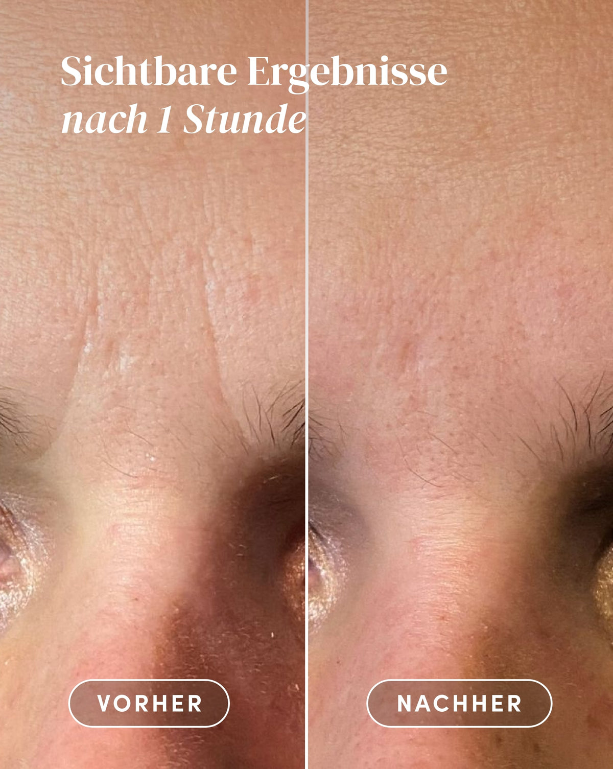 Vorher-Nachher-Ergebnis nach Anwendung der Niacinamid Zornesfalten Patches aus Bio-Baumwolle