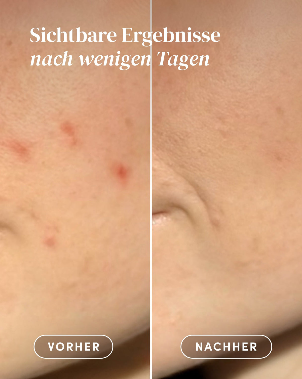 Vorher-Nachher-Ergebnis nach Anwendung der Post-Pickel Patches mit Alpha-Arbutin und Niacinamid